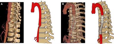 Delayed diagnosis of blunt thoracic aortic injury due to thoracic vertebral fracture: A case report and literature review